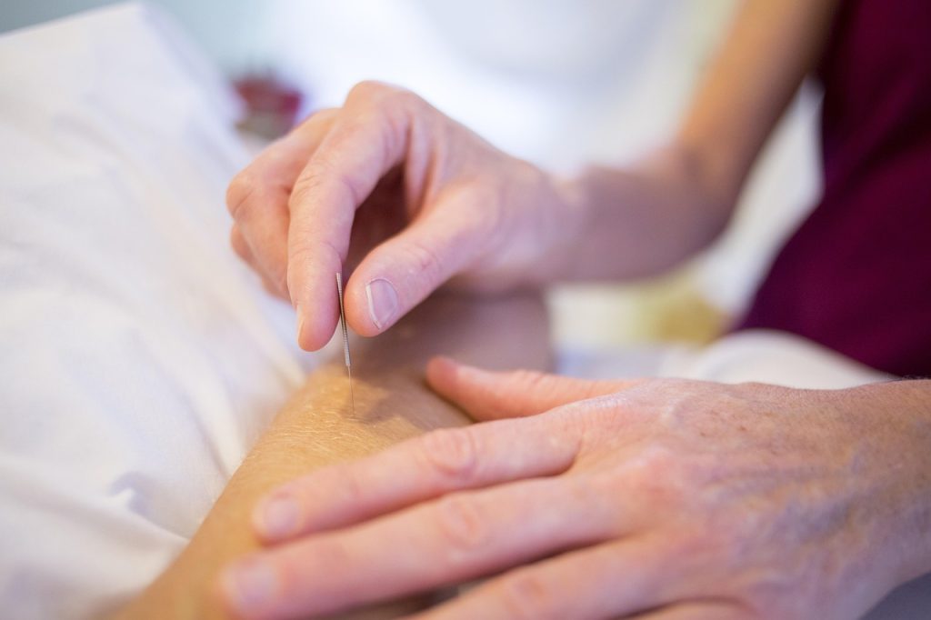 acupuncture